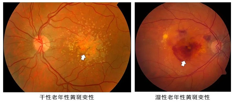 水蛭素、黃斑變性