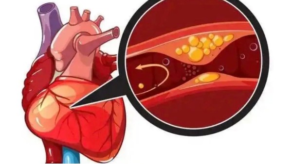 真實(shí)案例：是什么讓他堅(jiān)持一年，冠狀動(dòng)脈堵塞消除30%！