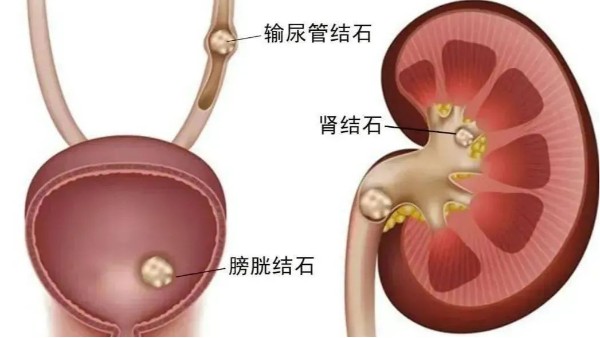 重用、活用水蛭治療尿路結(jié)石，療效較好