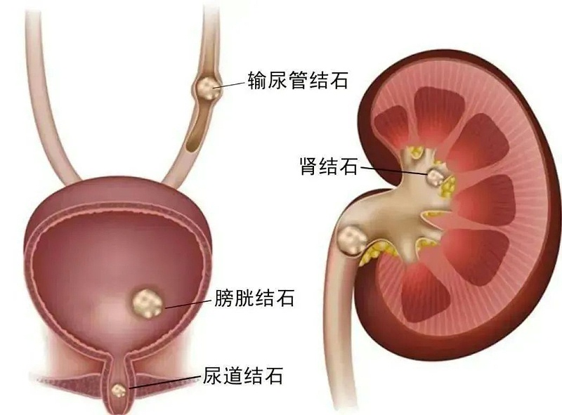 水蛭素、尿路結(jié)石、腎功能