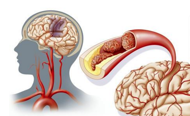 水蛭素、急性腦梗死、中風