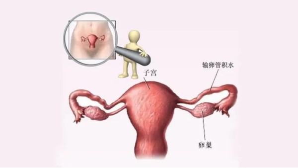 水蛭有利水道、破積聚之功，可用于治療輸卵管積水