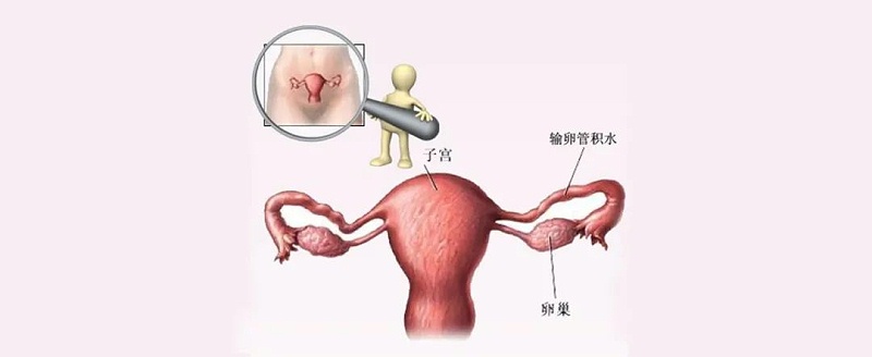 水蛭素、輸卵管積水、不孕不育