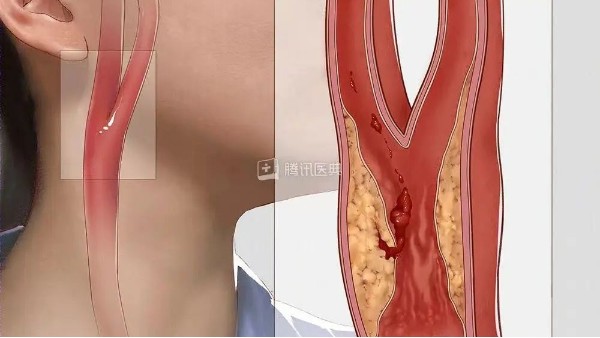 真實(shí)案例丨3個(gè)月左頸動(dòng)脈狹窄降低約27%，是怎么實(shí)現(xiàn)的？