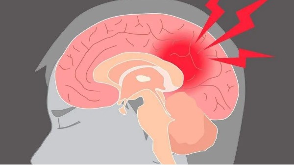 水蛭治療缺血性腦血管病療效肯定、安全簡便，已被各家公認