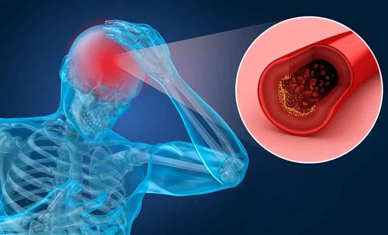 水蛭素、腦梗死、腦中風