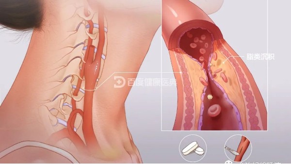 真實(shí)案例 | 從有到無，一個(gè)月多雙頸動(dòng)脈斑塊“消失術(shù)”
