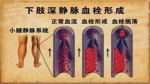 水蛭素、水蛭素膠囊、壯醫(yī)水蛭療法