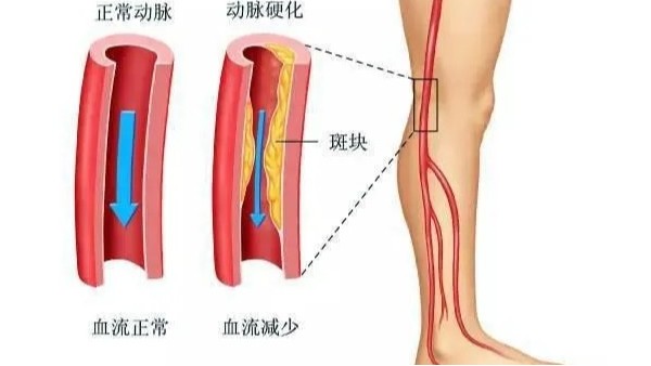 水蛭在改善下肢動脈硬化性閉塞癥中發(fā)揮重要療效，安全性及可行性較高