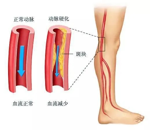 水蛭素、下肢動(dòng)脈硬化、下肢閉塞