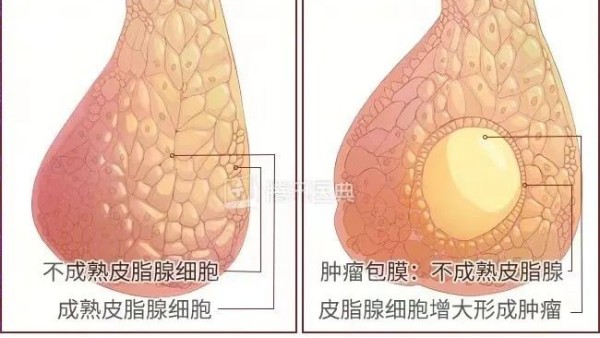 真實(shí)案例 | 腫瘤克星，百姓福音——現(xiàn)代壯醫(yī)水蛭療法