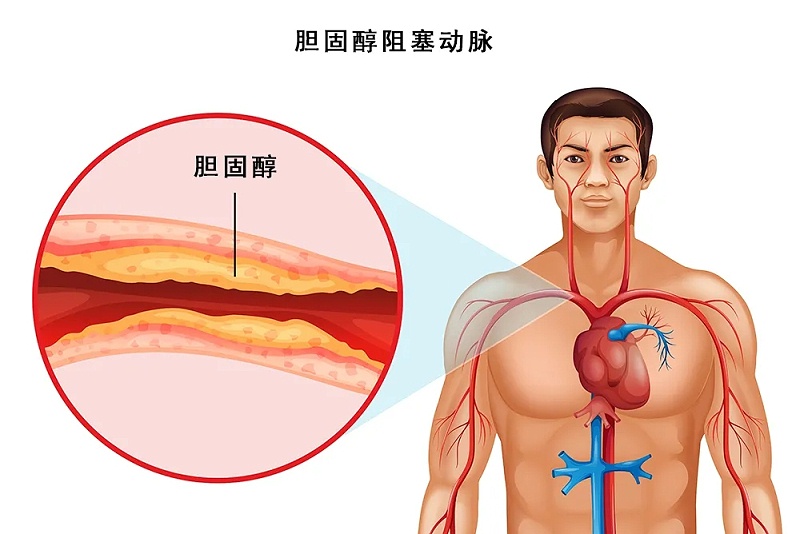 水蛭素、脖子粗、血管硬化