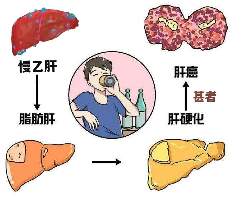 水蛭素、肝硬化、脂肪肝