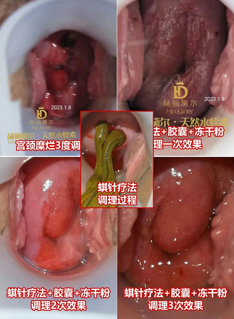 水蛭素、水蛭素膠囊、生殖婦科