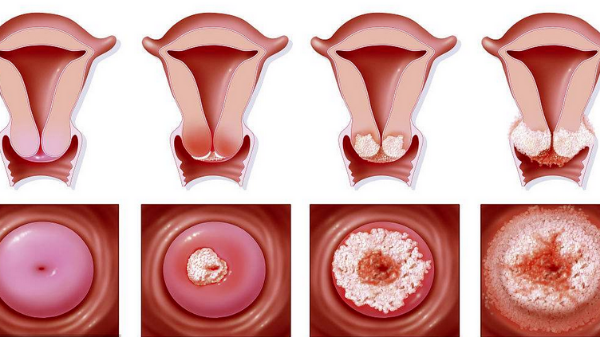 得了「宮頸糜爛」，怎么辦？