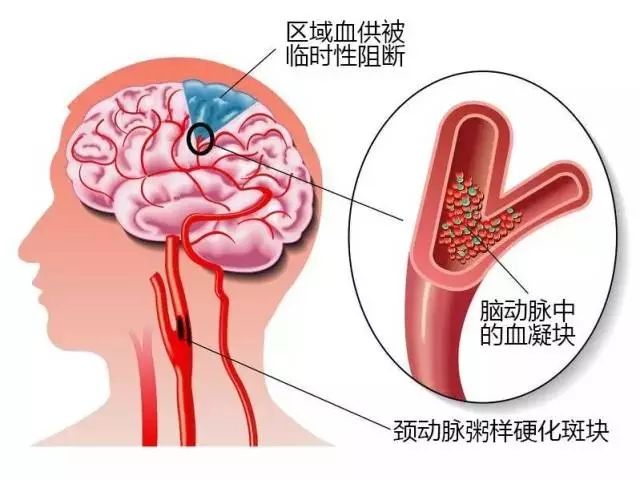 腦梗塞有什么預防方法