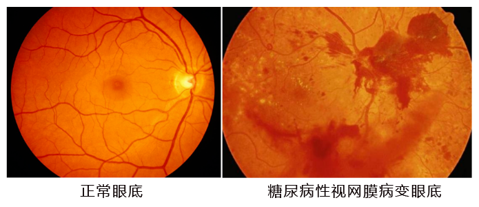 水蛭素、糖尿病、視網(wǎng)膜病變