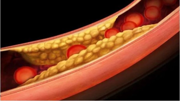 三高如何引起動脈粥樣硬化斑塊？——高血壓篇