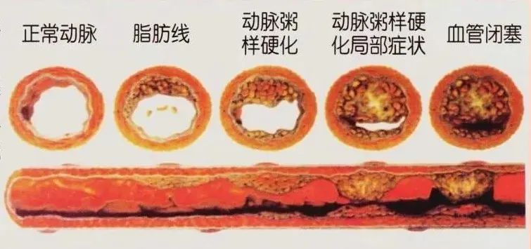 水蛭素、動脈粥樣硬化、高血壓