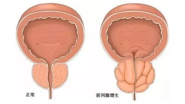 水蛭在改善前列腺增生臨床癥狀、提高生活質(zhì)量方面發(fā)揮重要作用