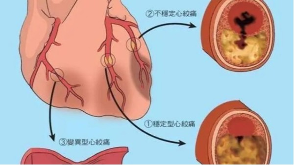 尿酸高不僅導(dǎo)致痛風，還可能威脅你的心臟和大腦！