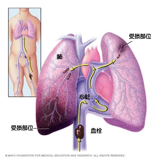 水蛭素、猝死、心梗